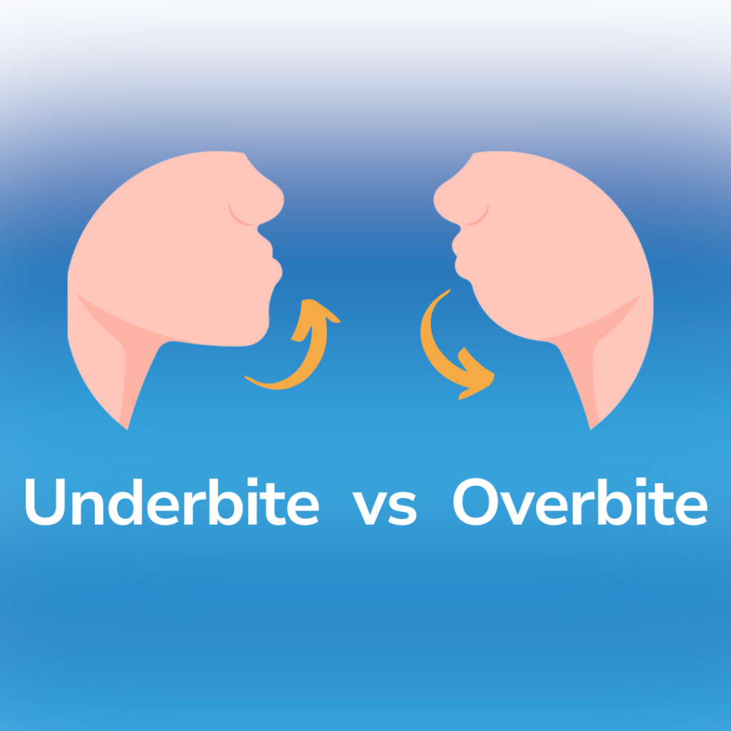 Overbite vs Underbite