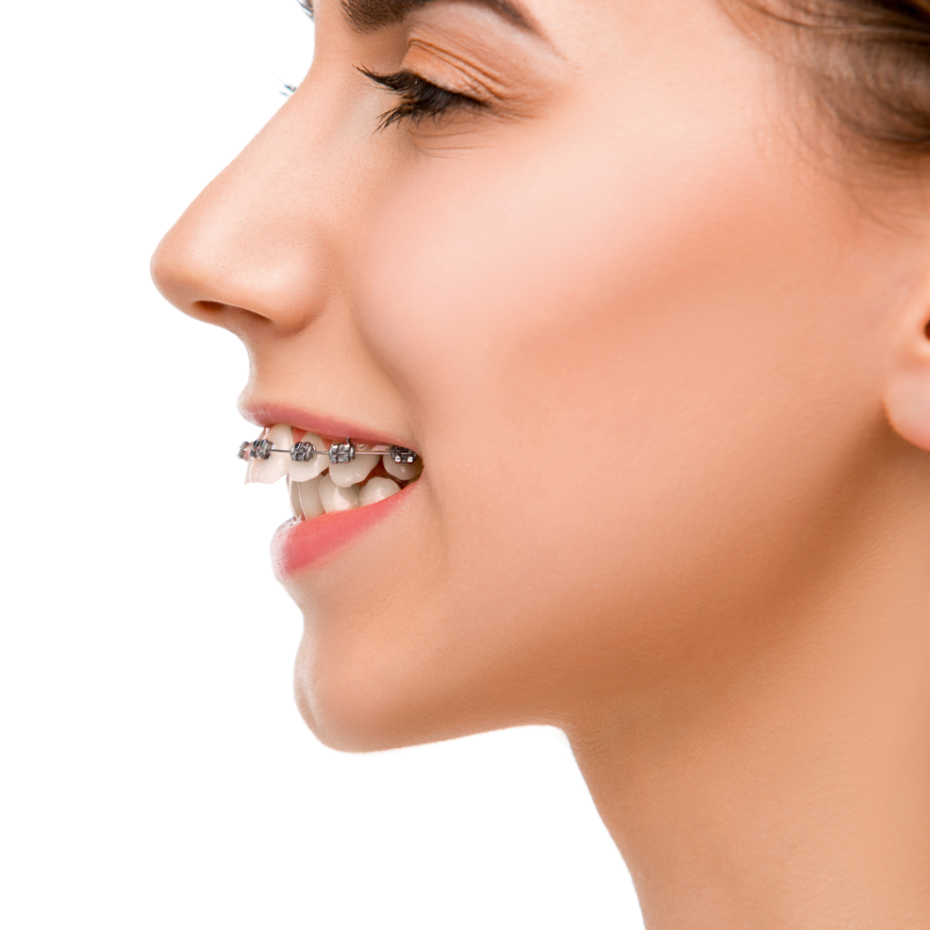 how to fix an overbite