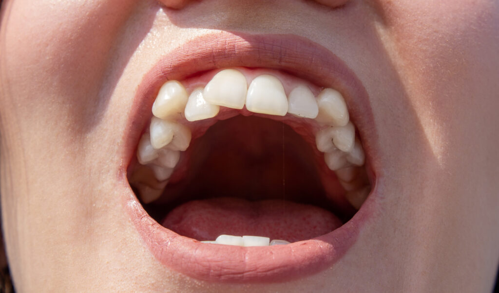 Braces before and after crowded teeth